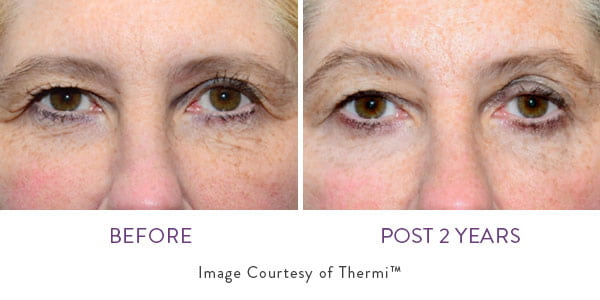thermismooth face before and after
