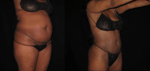 Smart Lipo Before & After
