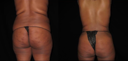 Smart Lipo Before & After