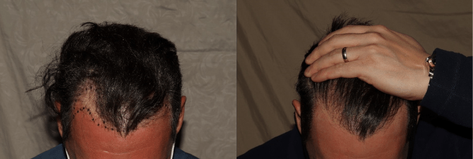 Hair Transplant_1 (670 × 226 px)