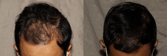 Hair Transplant_2 (670 × 226 px)