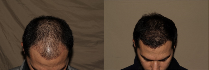 hair transplant before and after