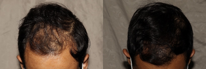 Hair-Transplant_2-670-×-226-px.png