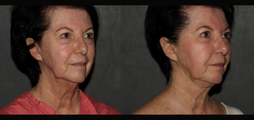 MyEllevate Before & After Jawline Contouring Philadelphia