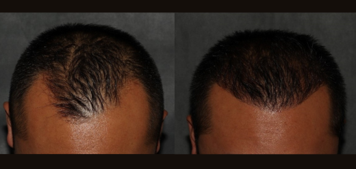 MY_Hair Transplant_520x247